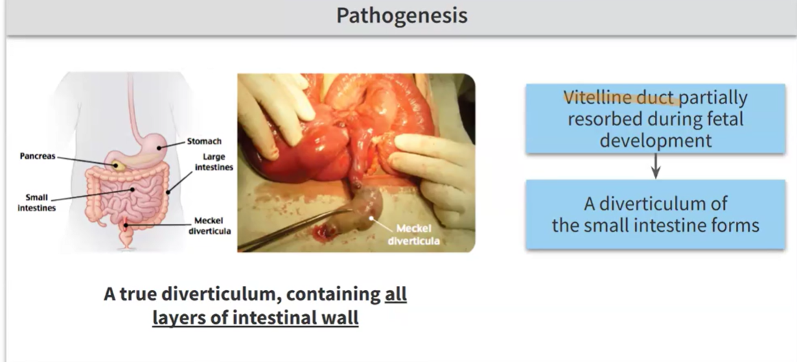 <p>Reman portion of embryonic vitelline duct. You will see painless rectal bleeding. Rule of 2s: 2 years old, 2 feet from ileocecal valve, males</p>
