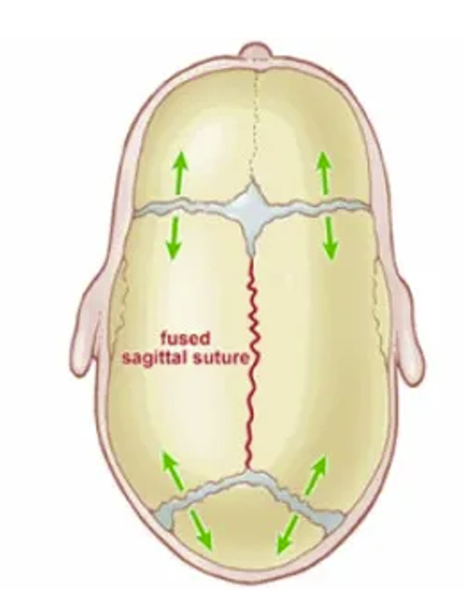 <p>Compensatory overgrowth occurs parallel to the fused suture.</p>