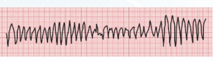 <p><strong><u>TORSADES DE POINTES</u></strong></p><p>Tachycardia in setting of QTc prolongation</p><ol><li><p>Treatment →</p></li><li><p>MOA → (3)</p></li></ol><p></p>