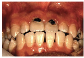 <p>the dental caries shown on teeth #8 and #9 are which class of dental caries?</p>