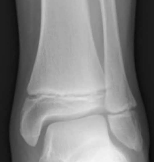 <p>fracture that involves at least part of the epiphyseal plate; occurs only in children and young adults. </p>