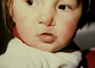 <p>AD, CL+CP or CP only, paramedian lip pits </p>