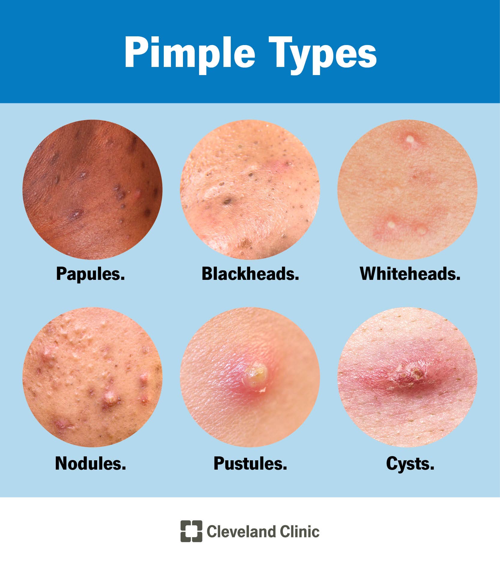 <p>Common types of acne lesions include comedones, papules, pustules, nodules, and cysts. </p>