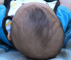 <p>positional plagiocephaly</p>