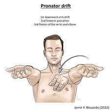<p>Pronator drift from supine </p>