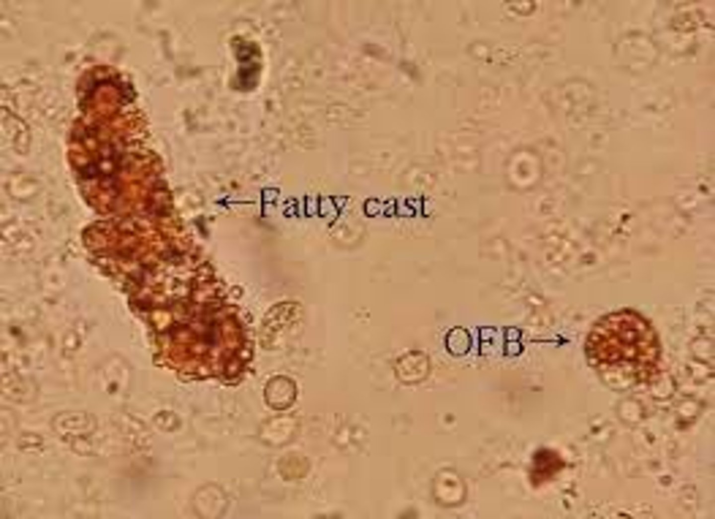 <p>Nephrotic syndromeephrotic syndrome</p><p>A kidney disorder that causes the body to excrete too much protein in the urine.</p>