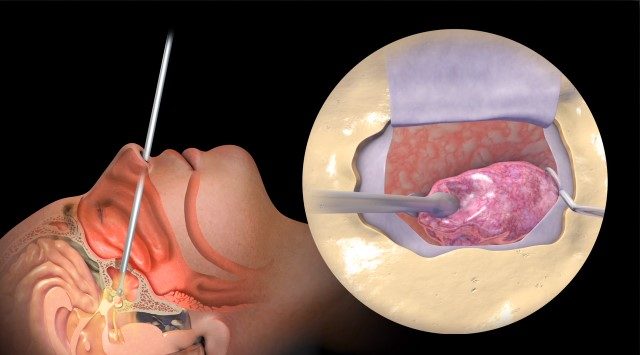 <p>one of your patients just came back from surgery to repair pituitary hypofunction. to do this, the pituitary gland was removed. </p><p>what comps should the nurse assess for post-op?</p>
