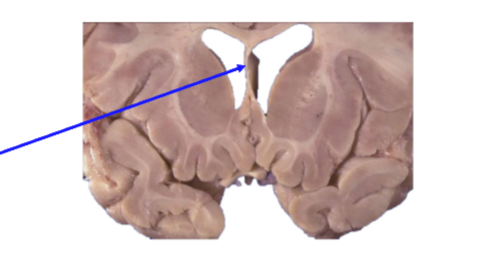 <p>Septum Pellucidum</p>