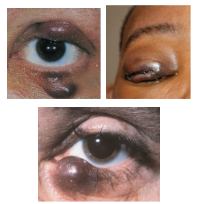 <p>What is the most likely diagnosis ?</p>