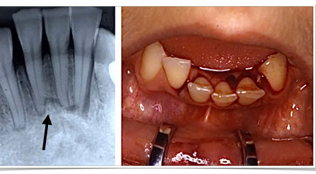 <p>-refer to OMFS</p><p>-whole section moves in a mass</p><p>-splint 4 weeks</p><p>-don’t do RCT</p>