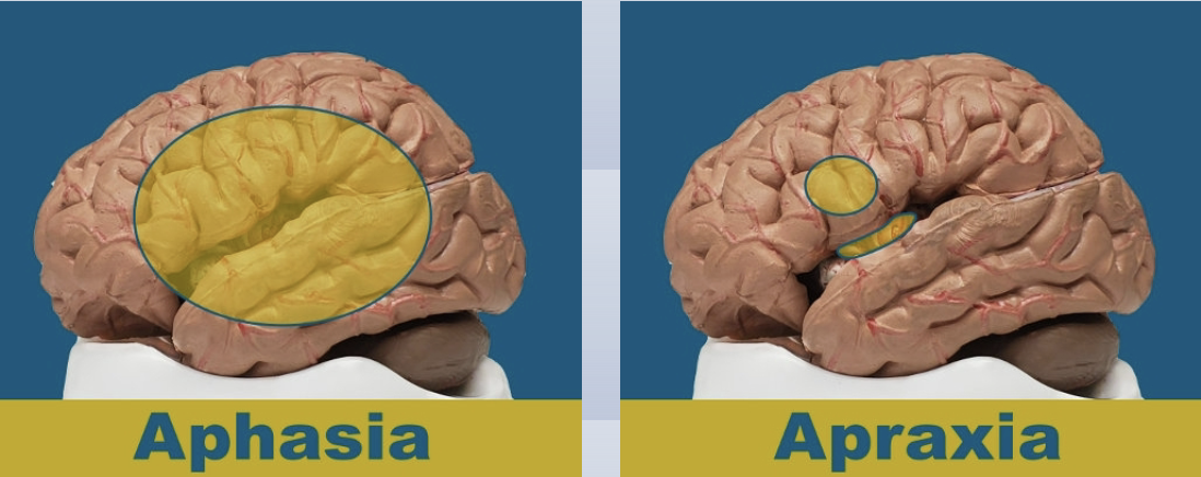 <p>Injury to premotor strip; if someone has Broca’s aphasia also assess for apraxia because Broca’s injury often spans the area affecting praxis</p><ul><li><p>know their not right, but can’t figure out how to fix it→ frustration</p></li></ul><p>assessment- Arnadottir OT-ADL neurobehavioral evaluation (A-ONE), apraxia screen of TULIA (AST)</p><p>treatment: specific gestural or strategy training is recommended for apraxia during acute rehab for L hem. stroke</p><ul><li><p>gestural: transitive to intransitive to instransitive-nonsymbolic gesture; use personally relevant stimuli</p></li><li><p>strategy training: initiating with proper plan of action and selection of objects to activity execution to controlling own performance</p><ul><li><p>grading instructions, assistance, and feedback</p></li></ul></li></ul><p></p>