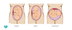 <p>- part of fetus that presents itself lowest in birth canal</p><p>- mc cephalic</p>