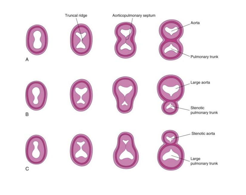<p>The truncus divides unequally •</p><p> Aorta must override the ventricular septum by less than or equal to 50% • </p><p>Aorta may be dilated due to flow from both ventricles</p><p>(2 types we will discuss today include: • Stenosis, and absence of the Pulmonary valve)</p>
