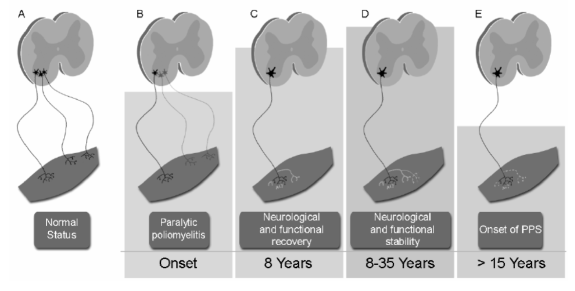 <ol start="3"><li><p>Infected motor neurons die cutting off electrical signals to muscles </p></li><li><p>Muscles weakness and flaccid paralysis result. Muscle lose tone and responsiveness and show atrophy (shrivel) </p></li><li><p>Later in life some develop <strong><u>post polio syndrome </u></strong></p></li></ol><p></p>
