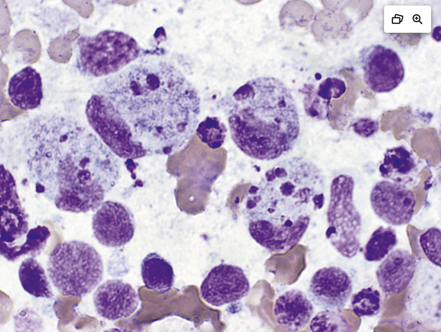 <p>cytologie ganglion lymphatique</p><ul><li><p>diagnostic</p></li><li><p>Cellules présentes </p></li><li><p>Elements cellulaires absents</p></li></ul><p></p>