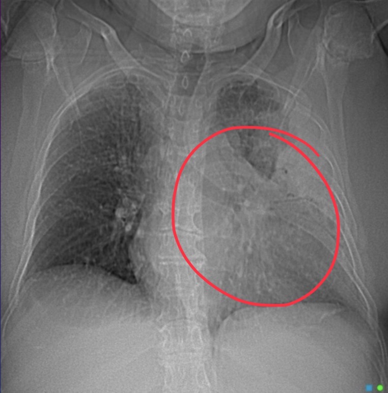 <p>55-year-old male is a smoker presents with chest pain. Fever and cough. Clinicians are worried about seeing cancer on a chest x-ray.</p>