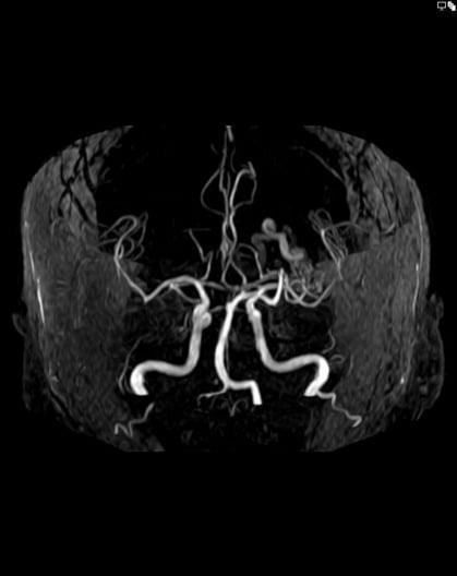 <p>Abnormal direct connection between arteries and veins, bypassing the capillary bed and causing arteriovenous shunting </p><p>-Types: pulmonary, cerebral, hepatic, peripheral</p><p>-Dx: CT angiography </p><p>-Tx: embolization (pulm), brain surgery (cerebral)</p>