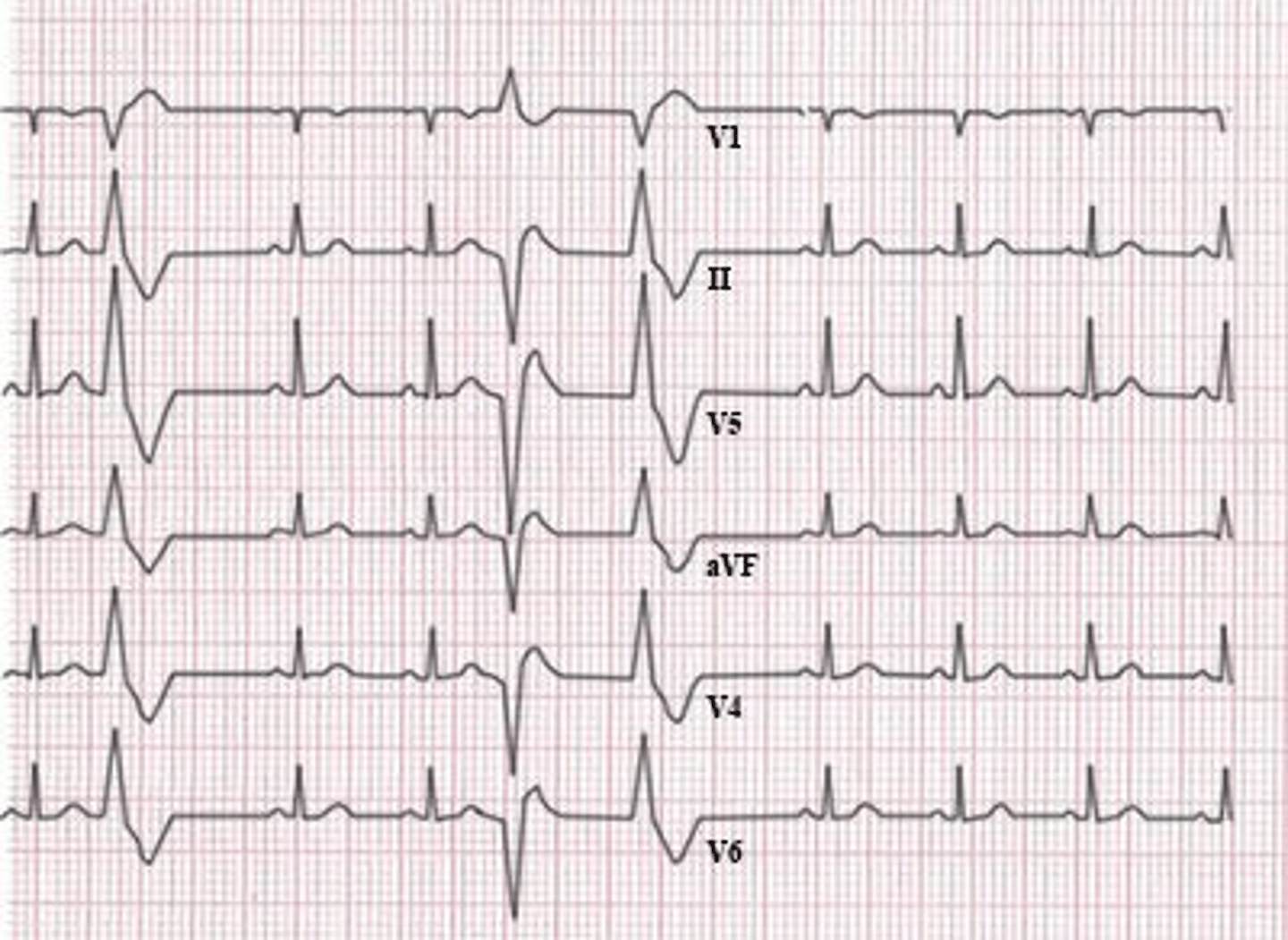 <p>3,2</p><p>1. The ST segment is not elevated in the photograph of the electrocardiogram</p><p>2. Premature ventricular contractions are present in the photograph of the electrocardiogram, as evidenced by the wide QRS complex and absent P wave</p><p>3. Acute first-degree atrioventricular block would be represented by a prolonged PR interval, which is not shown in this photograph</p><p>4. This electrocardiogram is not consistent with a normal response to exercise, because premature ventricular contractions are present</p>