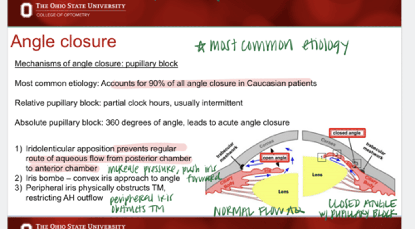 <p>What is the most common etiology of angle closure in Caucasian patients?</p>