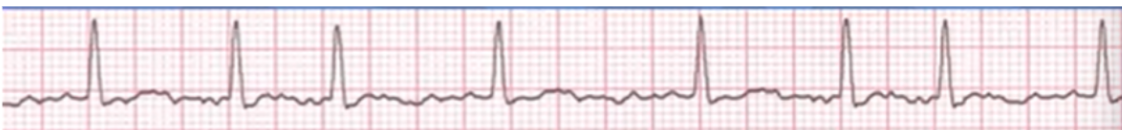 <ul><li><p><span style="background-color: transparent;">No organised atrial depolarisation, so no normal P waves (impulses are not originating from the sinus node)</span></p></li><li><p><span style="background-color: transparent;">Atrial activity is chaotic resulting in an irregularly irregular rate, R-R interval is irregular&nbsp;</span></p></li><li><p><span style="background-color: transparent;">Red flag for blood clots and strokes</span></p><ul><li><p><span style="background-color: transparent;">Heart rate: 100bpm</span></p><ul><li><p><span style="background-color: transparent;">If above classified as fast AF</span></p></li></ul></li><li><p><span style="background-color: transparent;">Rhythm: irregular&nbsp;</span></p></li><li><p><span style="background-color: transparent;">P waves: unclear, many</span></p></li><li><p><span style="background-color: transparent;">PR interval: unable</span></p></li><li><p><span style="background-color: transparent;">QRS complex: narrow at 0.08 seconds</span></p></li></ul></li></ul><p></p>