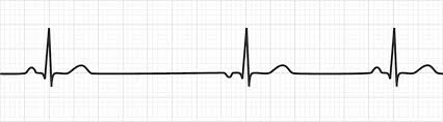 <p>howd yk this was an Atrial Escape Rhythm</p>