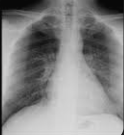<ul><li><p>Scapula over lung fields</p></li><li><p>Clavicles are above the apex of lung fields</p></li><li><p>Anterior ribs are distinct</p></li><li><p>Position of markers</p></li></ul><p></p>