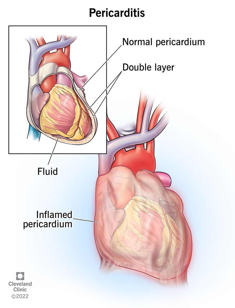 <p>A patient has chest pain that gets better when leaning forward. What condition could this be pointing to? </p>