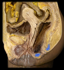 <p>anal canal surrounded by internal and external muscles</p>