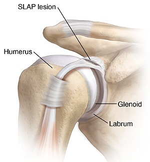 <p>This acronym stands for “Superior Labrum From Anterior to Posterior”;  it’s an injury to the superior labrum caused by large forces that have partially detached or tore the fibers the labrum is made up of</p><p><br>Common causes include:</p><ul><li><p>falling hard onto an outstretched arm or onto the shoulder</p></li><li><p>repetitive overhead motions like throwing or pitching</p></li><li><p>sudden, forceful pulling of the arm or lifting heavy items</p></li><li><p>gradual wear &amp; tear of the cartilage as you age</p></li></ul><p></p>