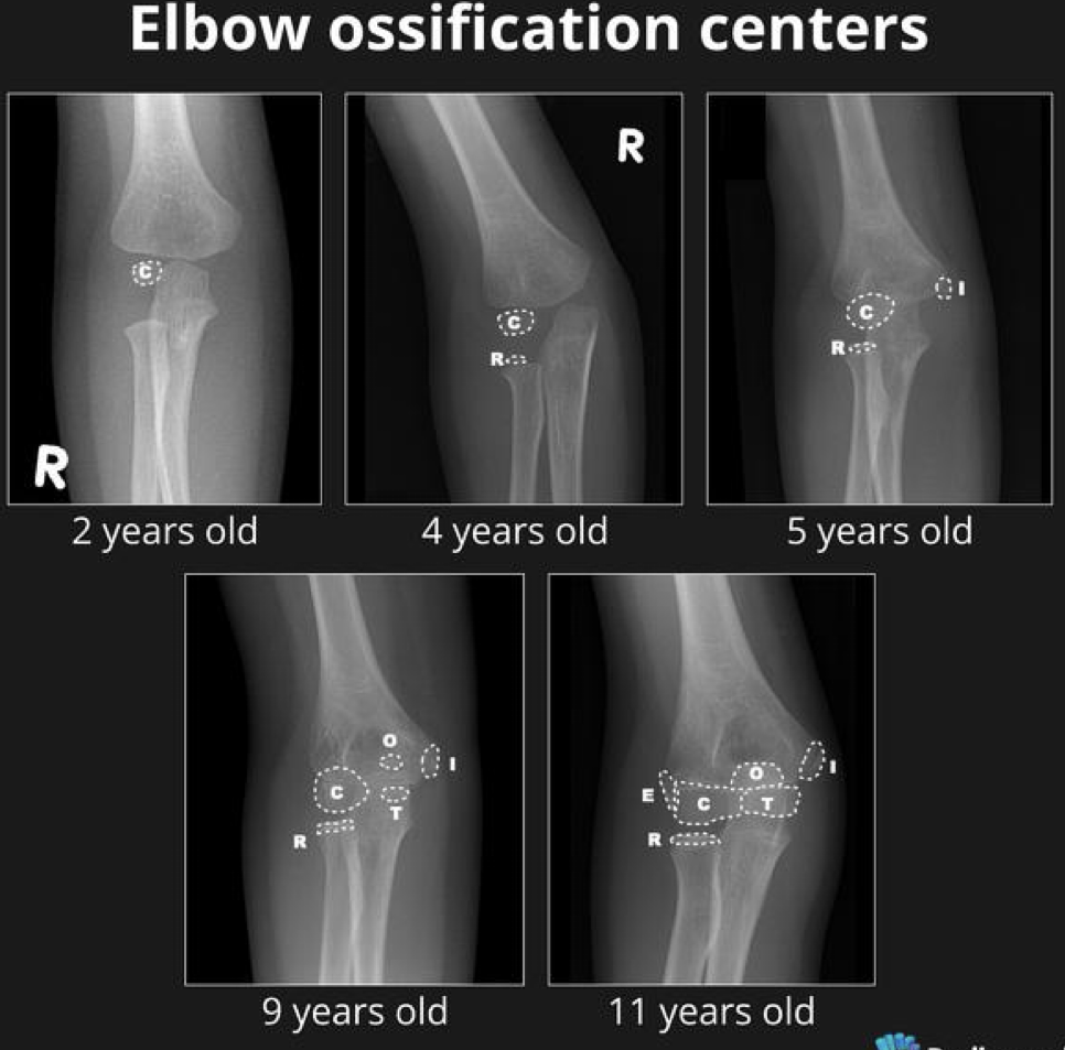 <p>capitellum</p><p>radial head</p><p>internal epicondyle</p><p>trochlea</p><p>olecranon</p><p>external epicondyle</p>
