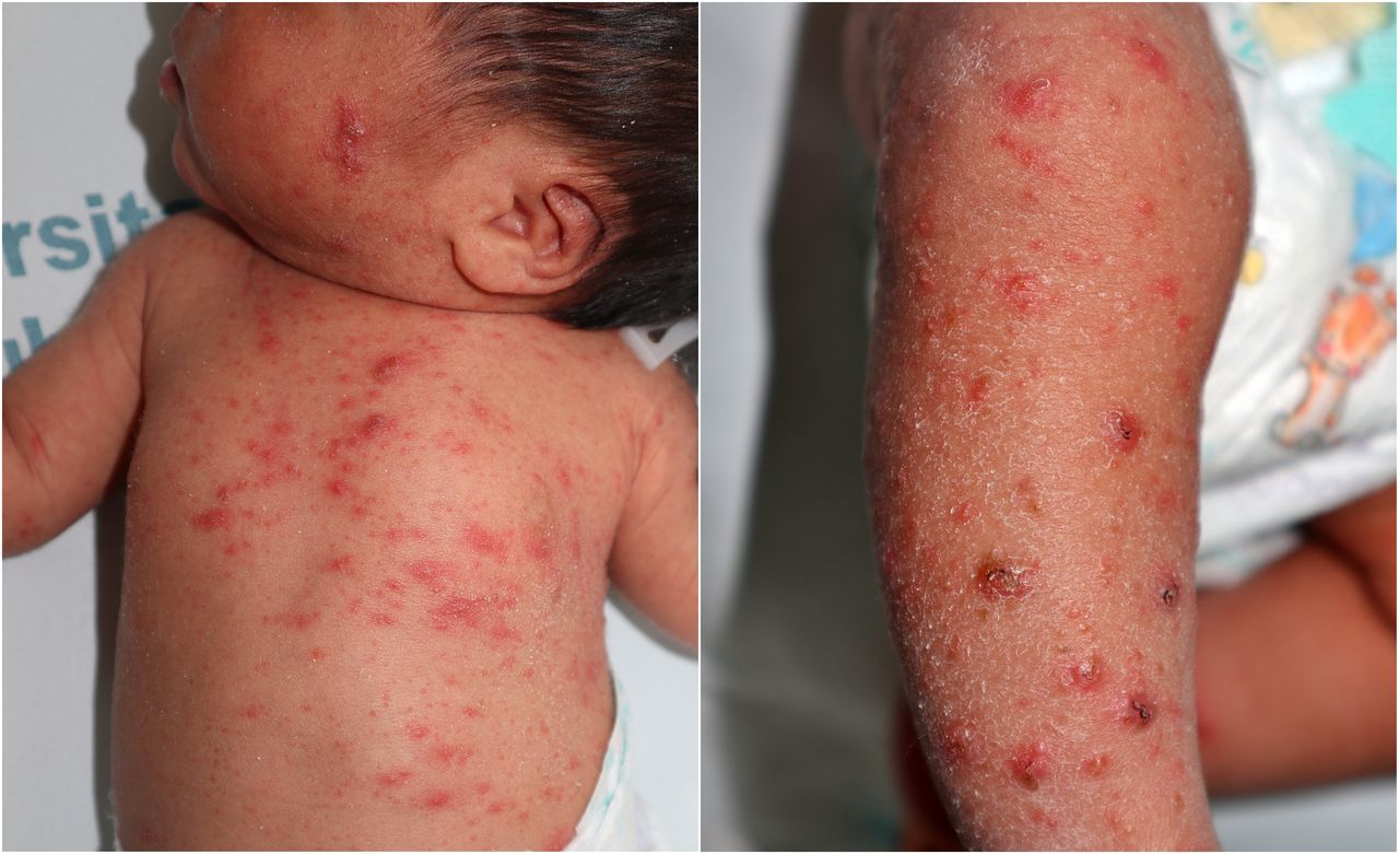 <ul><li><p>scabies <strong>mites</strong>, through direct contact</p></li><li><p><span style="color: rgb(208, 99, 195);"><strong>5% permethrin</strong> or <strong>Ivermectin </strong>cream</span></p></li></ul><p></p>