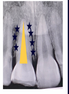 <p>-initiate RCT one week later</p><p>-place calcium hydroxide (pH 12.4)</p><p>-calcium hydroxide alters the pH of the external root surface and may necrose the PDL fibers trying to re-attach themselves</p><p>-RCT one week later (fate of PDL decided in the first week after avulsion)</p><p>-minimum 1 week to 6 months in calcium hydroxide</p>