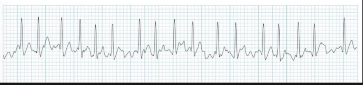 <p>rate: tachycardic, A lot of times in RVR</p><p>irregularly regular</p><p>measurements: hard</p><p>Most deadly rhythm we're learning this semester</p><p>atria shaking so there is no discernible P wave</p><p>There is poor cardiac output causing poor perfusion which can lead to clotting problems and stroke</p><p>Can be caused by atrial enlargement or structural heart disease, hypertension, valvular disease, ischemia</p><p>An atrial kick is the final atrial contraction that contributes to about 20 to 30%</p><p><strong>The goal is to control ventricular rate and rhythm, prevent thromboembolism or stroke and treat the underlying cause (heparin→ start 2nd line) (dont draw labs off of central line with heparin)</strong></p><ul><li><p>monitor PTT every 6 hours</p></li><li><p>before cardioversion, check for clots using TEE, if cardioversion doesnt work → ablasion (cauterize)</p></li></ul><ul><li><p>atria is not fully contracting</p></li></ul><p></p>