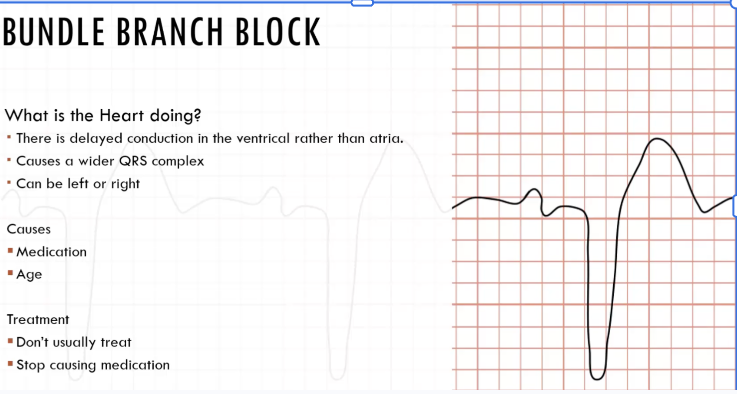 <p>bundle branch block</p>
