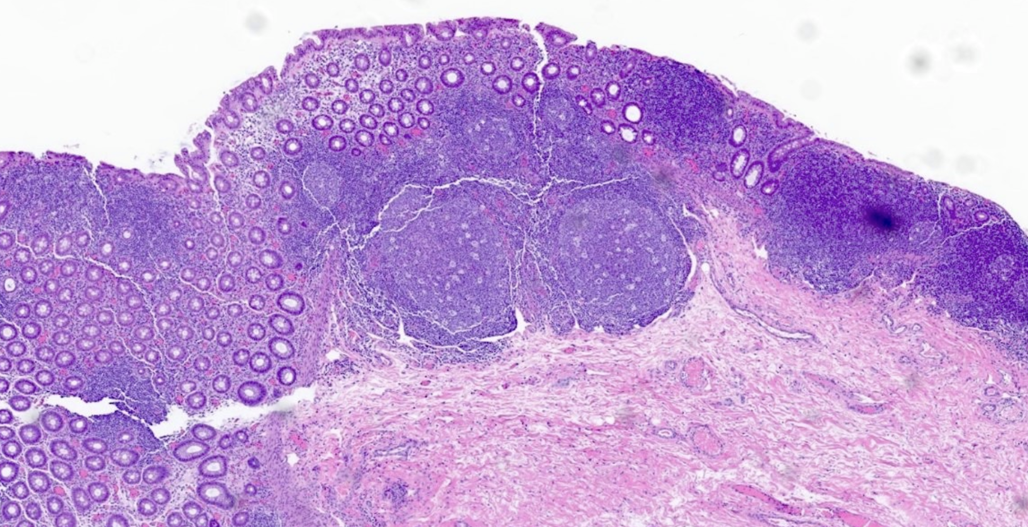 <p>Patient avec colostomie. Aspect inflammatoire du colon en aval. </p><p>1) Diagnostic </p><p>2) Signes histologiques </p>