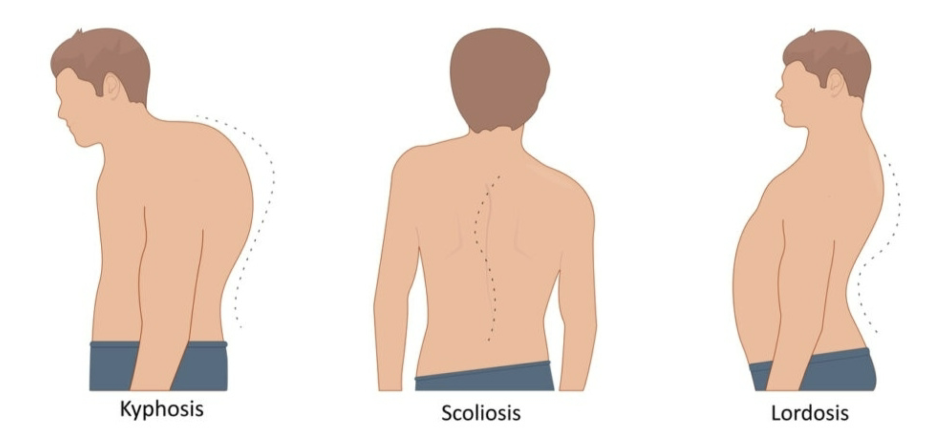 <p>Kyphosis (outward cervical), Scoliosis (S-shape lateral curve), Lordosis (thoracic inward)</p>