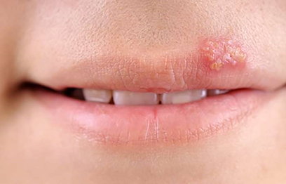 <p>Causative Agent: Herpes Simplex Viruses 1 and 2 (HSV-1&amp;2)<br>Symptoms/Signs: Sores on the skin of the lips; can infect the CNS</p>