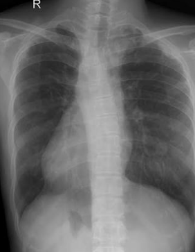 <p>what is this? </p><p>recurrent infections, infertility, apex of the heart on the right </p>