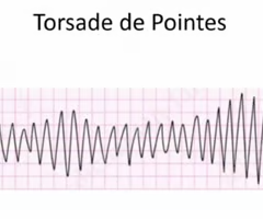 <p><span>is type of VTACH<br>tx: magnesium sulfate<br>can be caused by haloperidol, CNS disease</span></p>