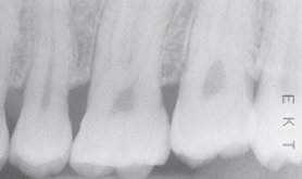 <p>Light Radiograph </p><p><strong>What it looks like:</strong><br>Image is <strong>too light</strong>.</p><p> </p><p><strong>Cause:</strong><br>Underexposure or underdevelopment.</p>