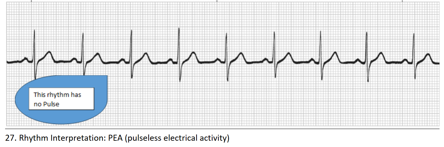 <p>Pulseless Electrical Activity (PEA)</p>