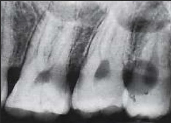 <p>What is spotted film caused by? (2)</p>