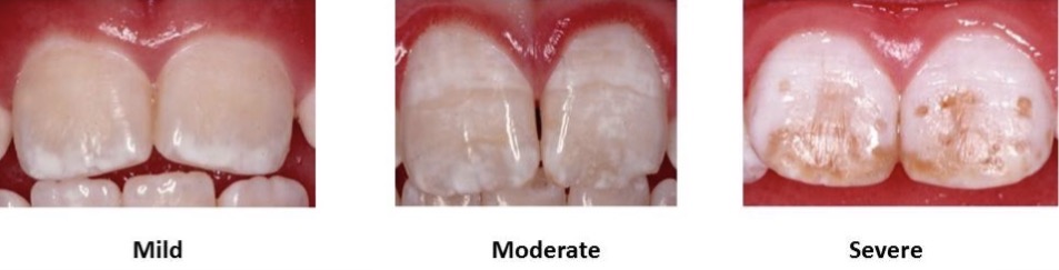 <p>Fluorosis </p>