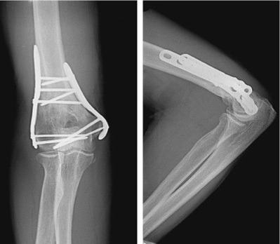 <p>Complications</p><ul><li><p>Volkmann’s Contracture</p><ul><li><p>Occurs in the absence of blood flow to the forearm</p></li><li><p>Causes muscles to shorten and contracture of forearm </p></li><li><p>Usually associated with elbow fractures, bleeding disorders, and animal bites</p></li><li><p>Sometimes cannot be reversed </p></li></ul></li></ul><img src="https://assets.knowt.com/user-attachments/bb17c135-5f18-49e3-8a08-f973aad5ca49.png" data-width="100%" data-align="center"><p></p>