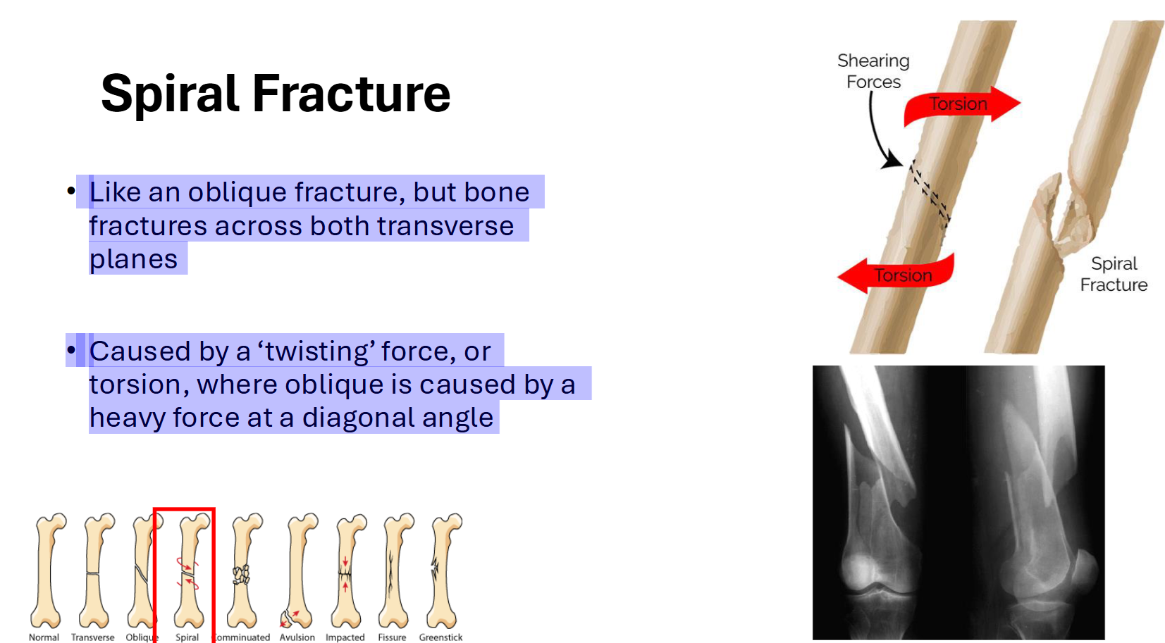 <p>Spiral Fracture</p>