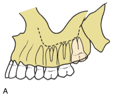 <p>easier for maxillary </p><p>often <span style="color: red;">straightforward removal</span></p><p>long axis parallel to second molar</p>
