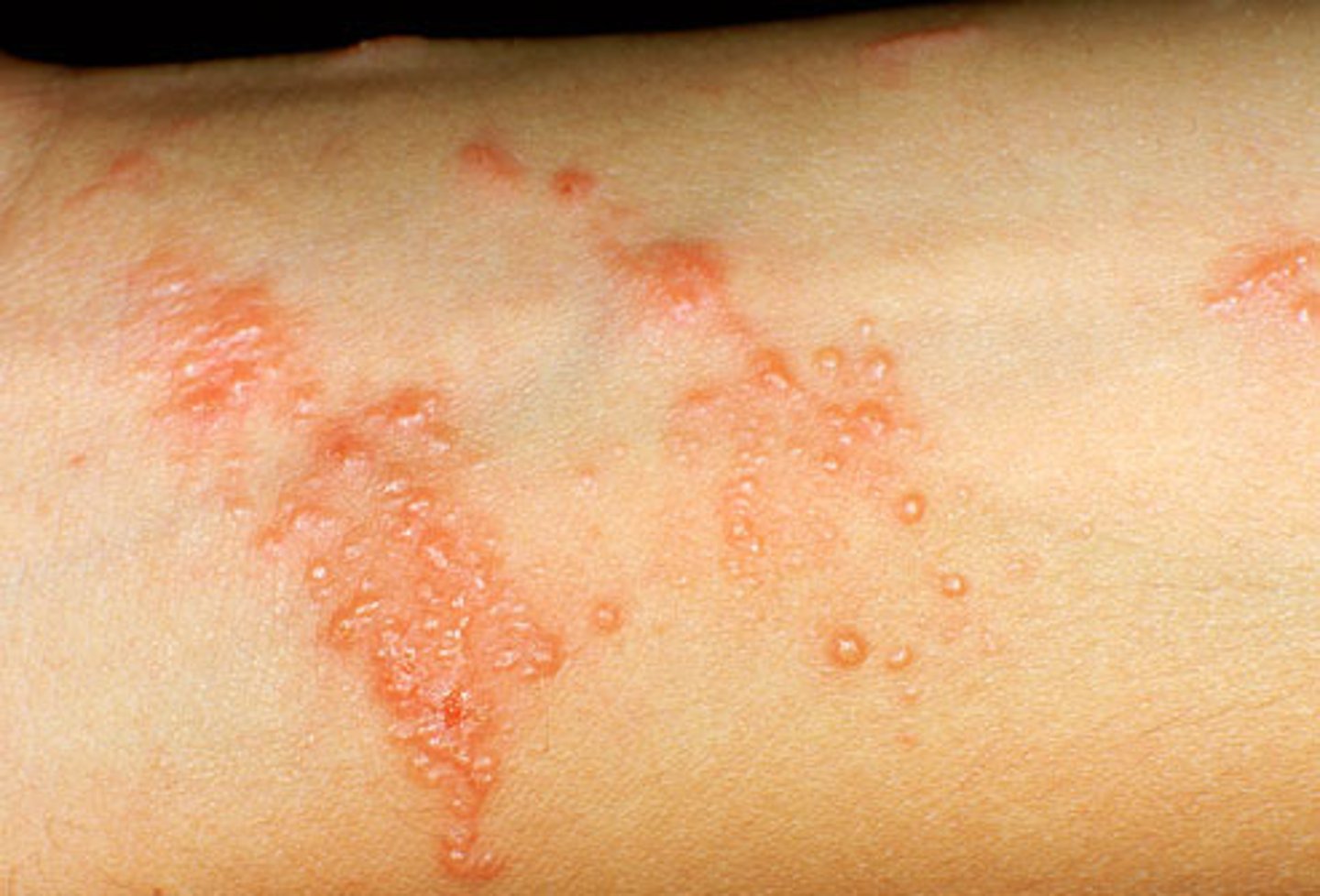 <p>Delayed type IV allergic reaction to Poision Ivy, Oak, and Sumac</p>