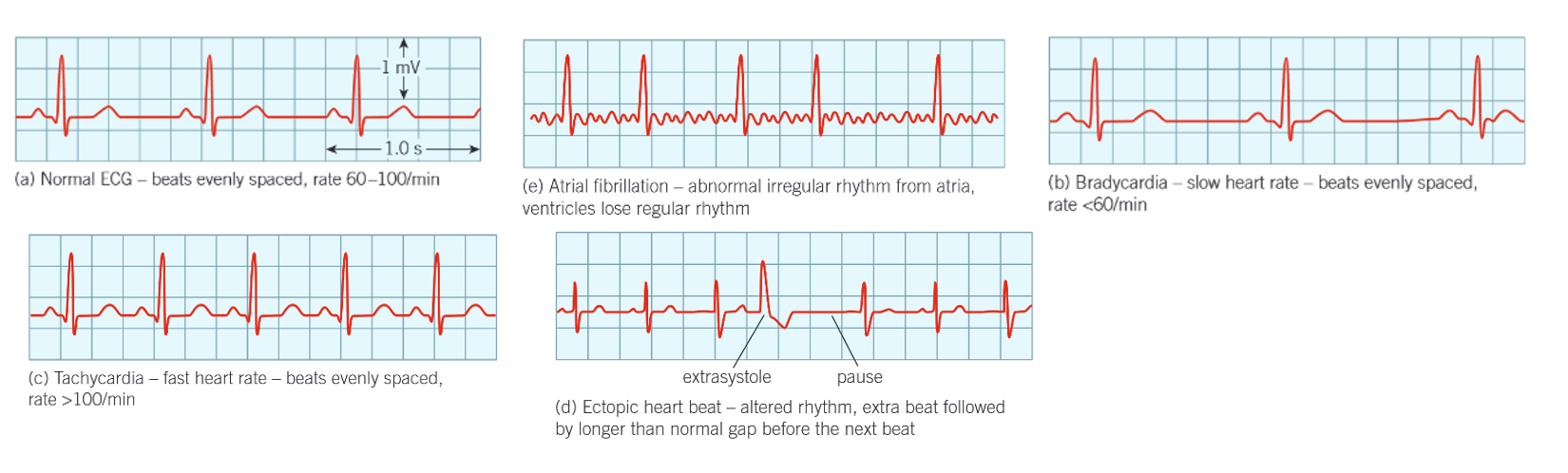 <ol><li><p>normal ECG </p></li><li><p>atrial fibrillation </p></li><li><p>bradycardia </p></li><li><p>tachycardia </p></li><li><p>ectopic heartbeat </p></li></ol><p></p>