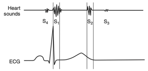 <p><u>Definition:</u> “Dub” = Closure of semilunar valves (aortic and pulmonic)</p><ul><li><p>Coincides with end of systole and after T wave</p></li></ul><p><u>Location:</u> Loudest over left heart base</p><p><u>Split S2:</u> Aortic and pulmonic valves close at different times due to</p><ol><li><p>Physiological in healthy, large-breed dogs</p><ul><li><p>Inspiration → increased RV filling → delayed closure of pulmonic valve</p></li></ul></li><li><p>Heartworm and pulmonic hypertension</p></li><li><p>Delayed closure of pulmonic valve: ASD, PS, right bundle branch block, ectopic beats</p></li><li><p>Premature closure of aortic valve: MS or MR</p></li><li><p>Delayed closure of aortic valve: AS, left bundle branch block, ectopic beats, systemic hypertension</p></li></ol><p></p>