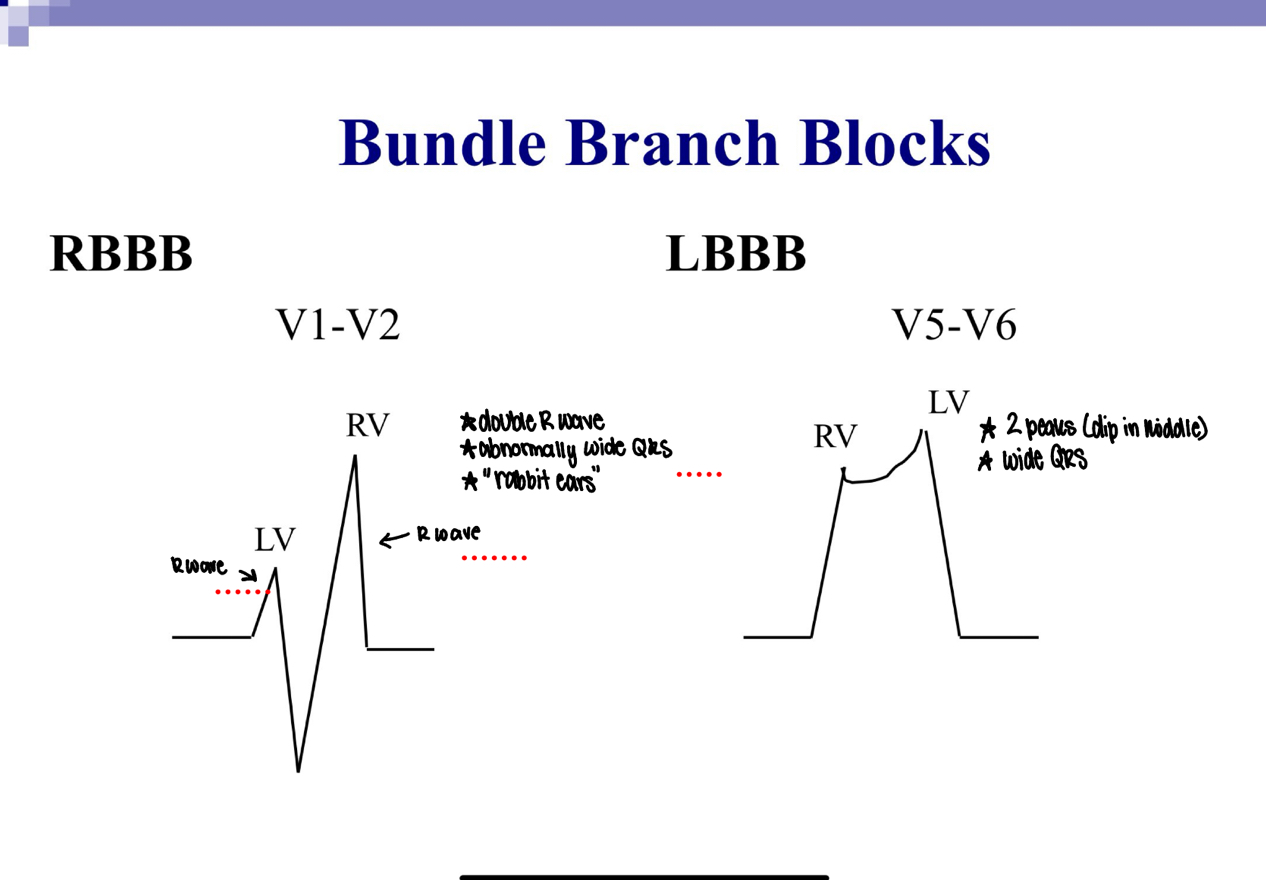 <p><strong>Bundle Branch Blocks</strong></p><p></p>
